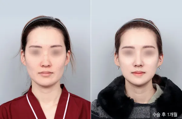 Before/After