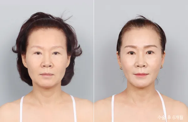 Before/After