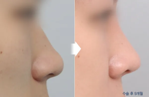Before/After