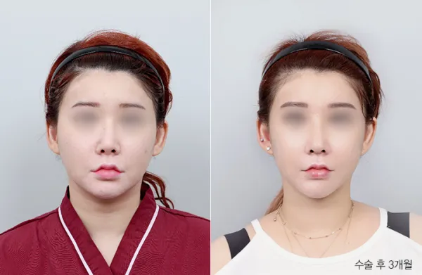 Before/After