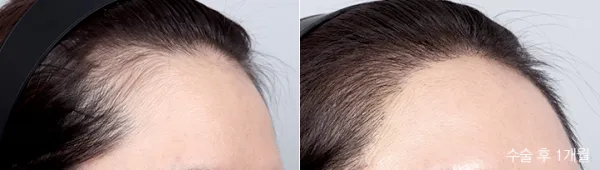 Before/After