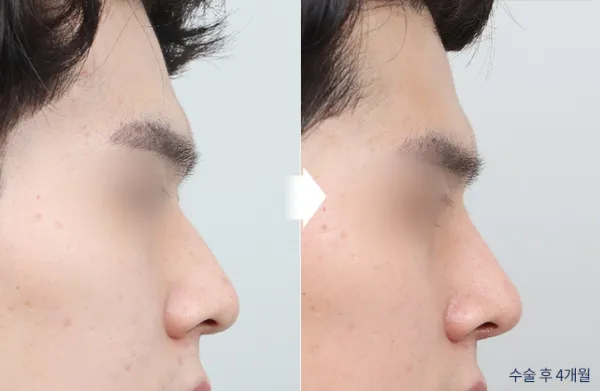 Before/After