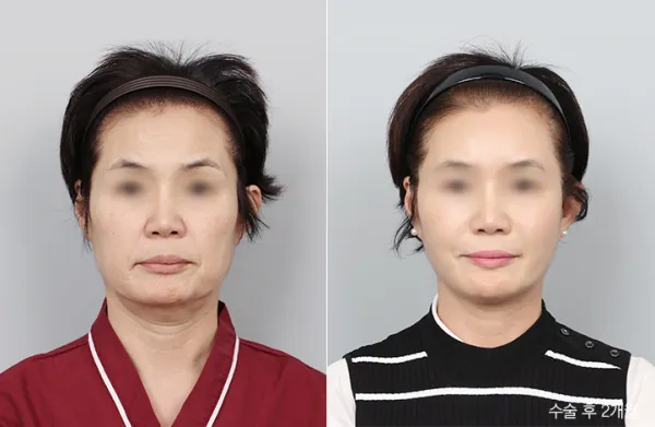 Before/After