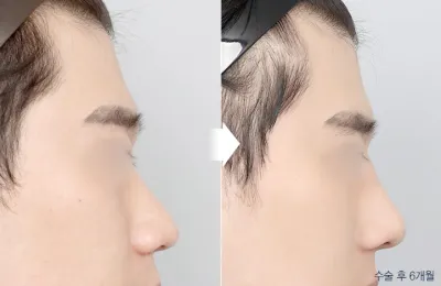 Before & After