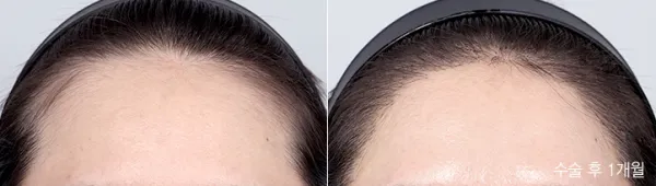 Before/After