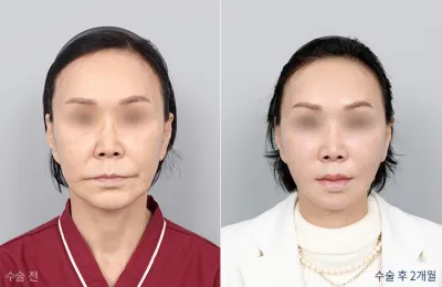 Before & After
