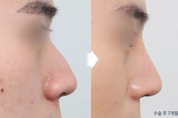 Before/After