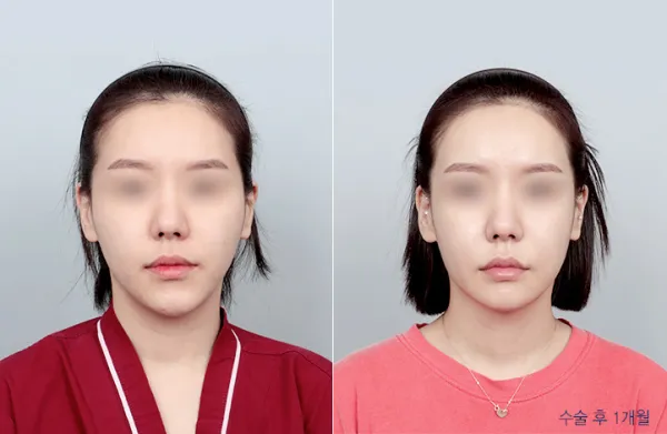 Before/After