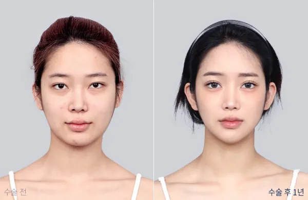 Before/After