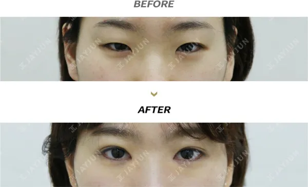Before/After