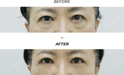 Before & After