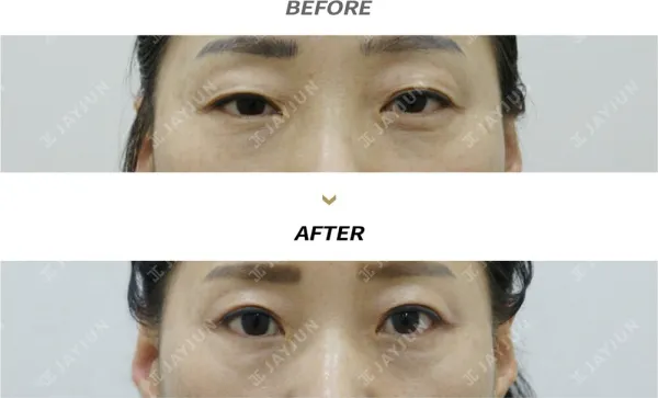 Before/After