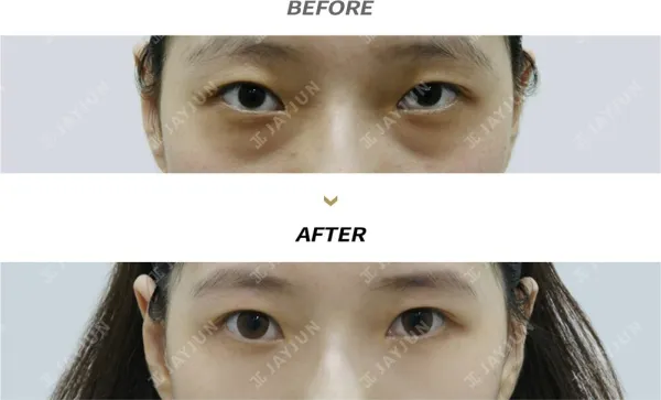 Before/After