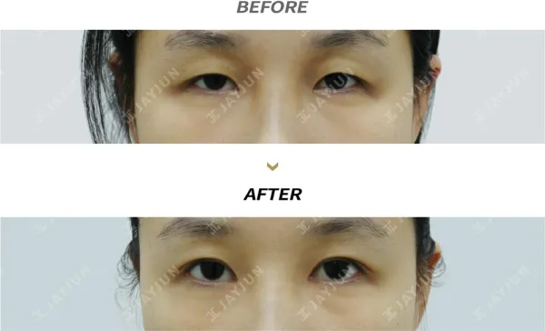Before/After