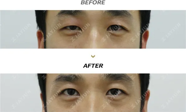 Before/After