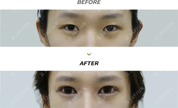 Before/After