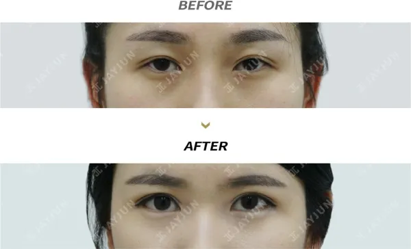 Before/After