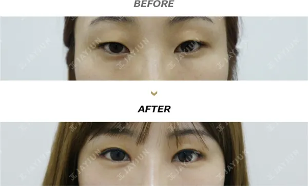 Before/After