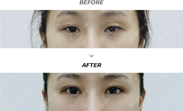 Before/After
