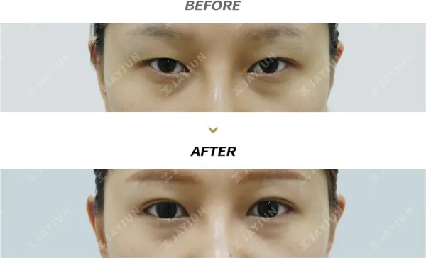 Before/After
