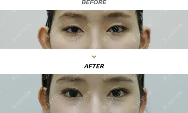 Before/After