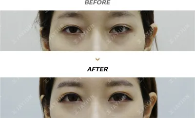 Before & After