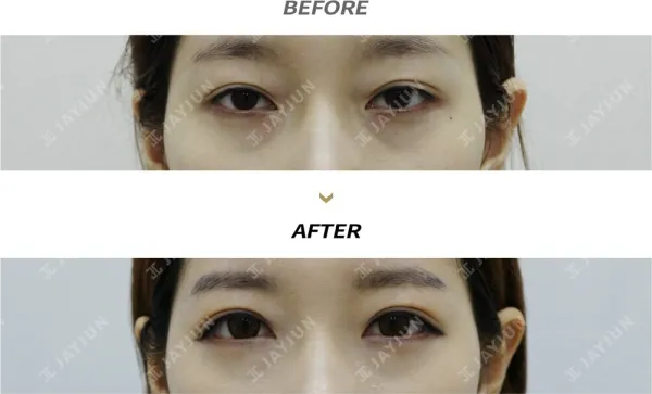 Before/After
