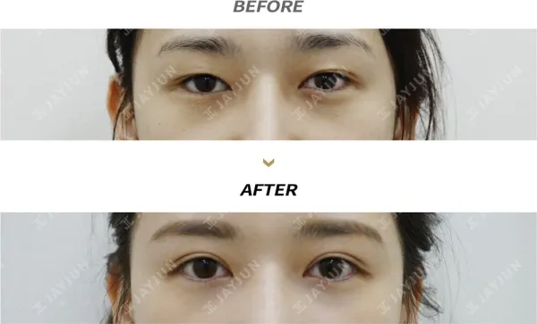 Before/After
