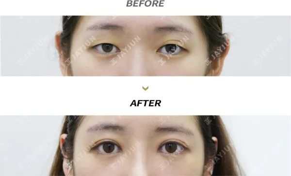 Before/After