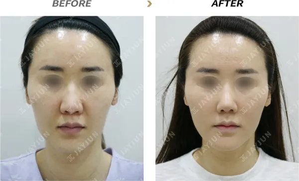 Before/After