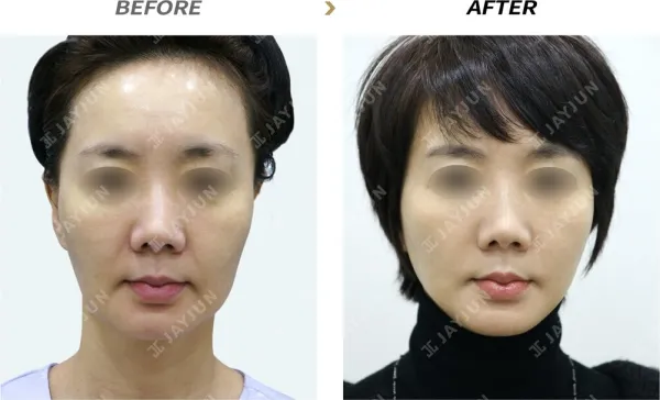 Before/After