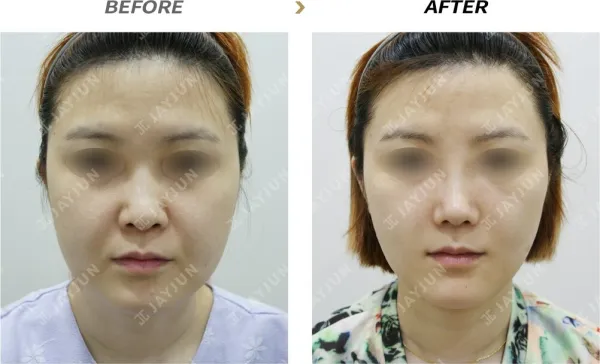 Before/After