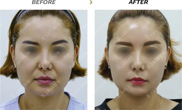 Before/After