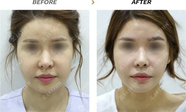 Before/After