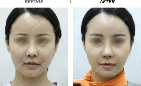 Before/After
