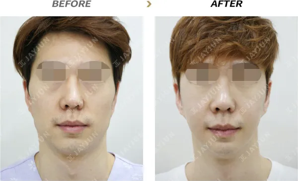 Before/After