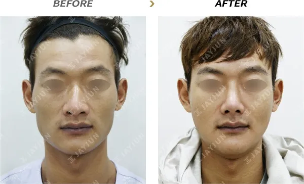 Before/After