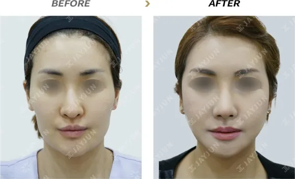Before/After