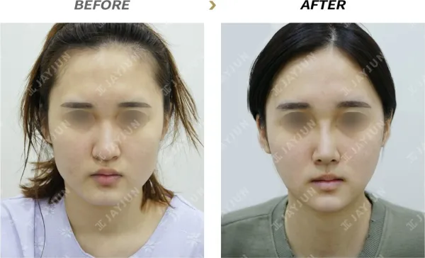 Before/After