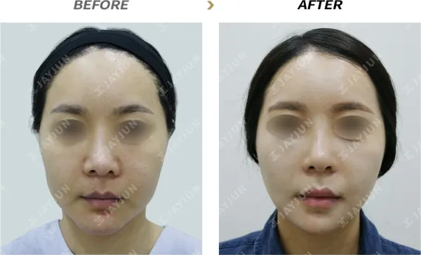 Before/After