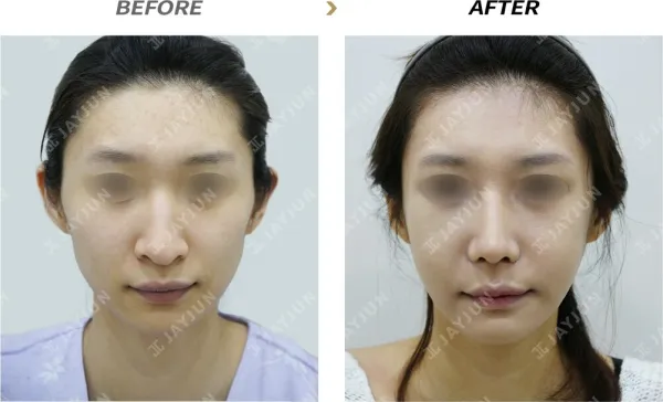 Before/After