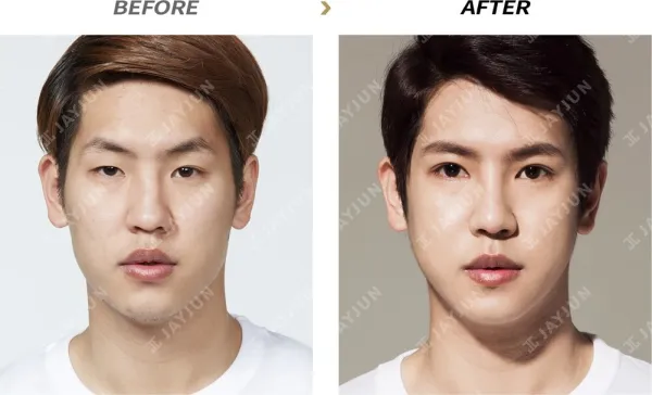 Before/After