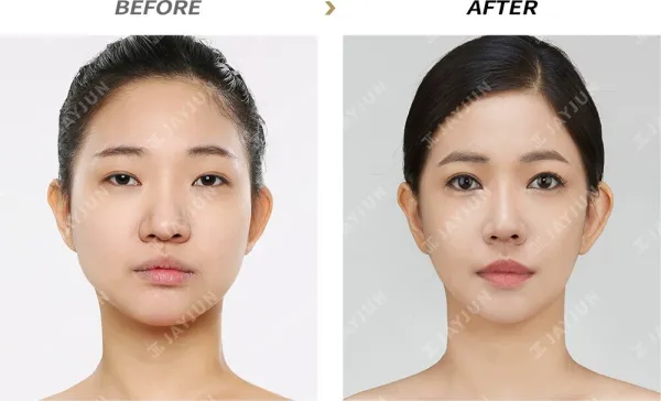 Before/After