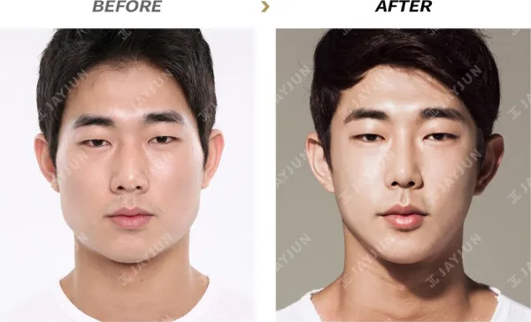 Before/After