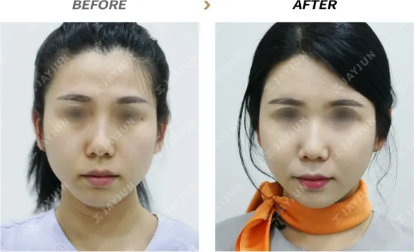 Before/After