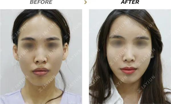 Before/After