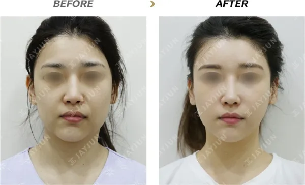 Before/After