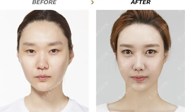 Before/After