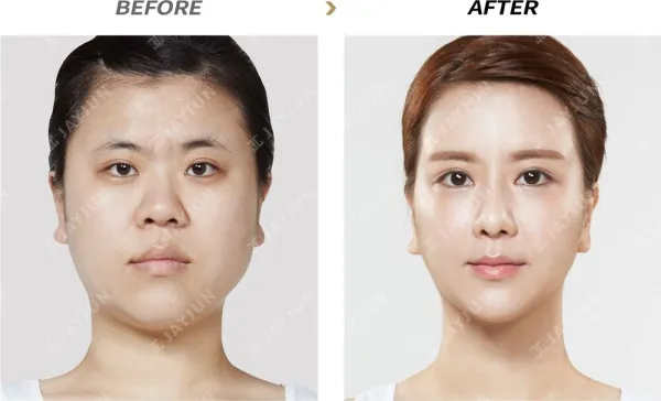 Before/After