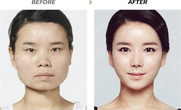 Before/After